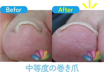 中等度の巻き爪の治療前と治療後の比較