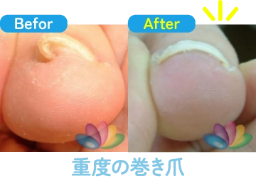 重度の巻き爪の治療前と治療後の比較